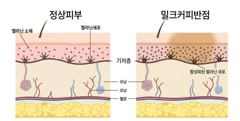 정상피부와 밀크커피반점 부위의 멜라닌 소체·활성화된 멜라닌 세포 분포를 비교한 피부 단면 설명 이미지
