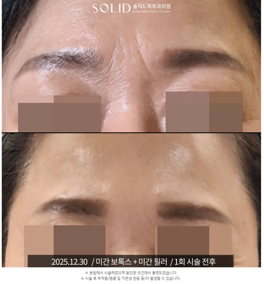 미간 보톡스와 미간 필러 1회 시술 전(위)과 후(아래, 2025.12.30) 미간 주름 임상사진(본원 시술·동일 조건 촬영 안내 포함), 개인차 있음