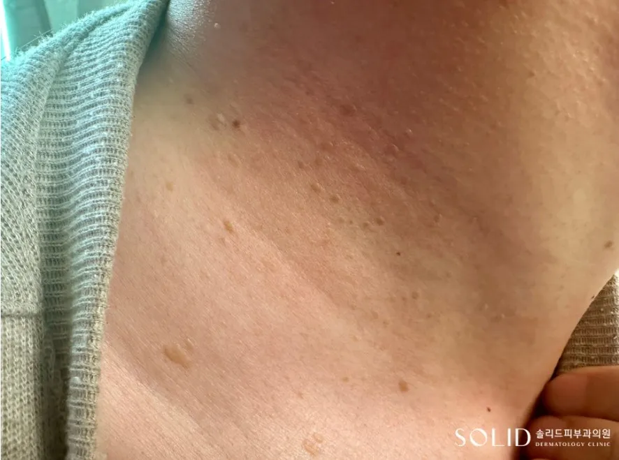 목과 쇄골 부위에 납작한 살색 구진이 여러 개 흩어져 있는 편평사마귀 임상사진