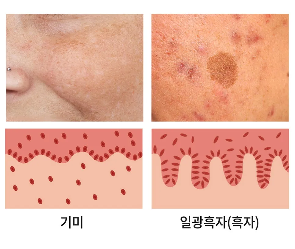 기미와 흑자(일광흑자)의 발생 층과 특징을 비교한 설명 이미지