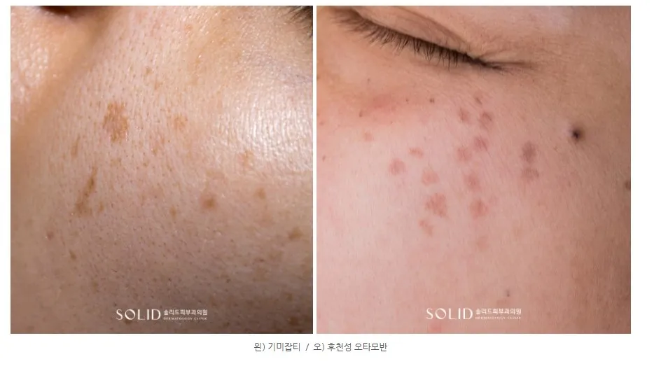 왼쪽은 볼의 기미 잡티, 오른쪽은 광대의 후천성 오타모반을 비교한 임상사진