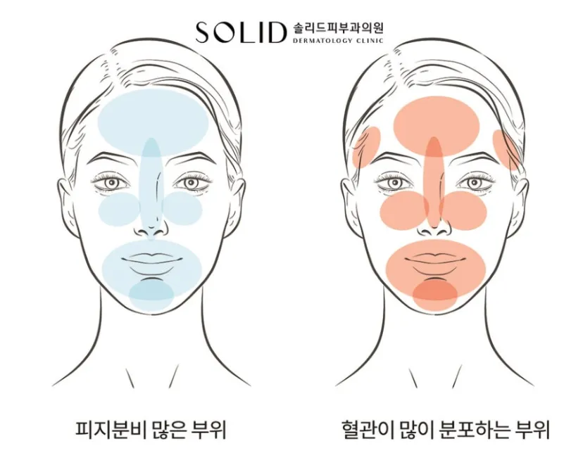 얼굴에서 피지분비가 많은 부위(T존)와 혈관이 많이 분포하는 부위를 표시한 설명 이미지