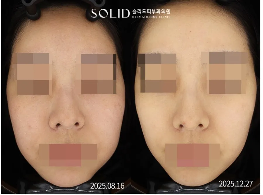 시그니처토닝 9회 전(2025.08.16)과 후(2025.12.27) 얼굴 정면 임상사진, 개인차 있음