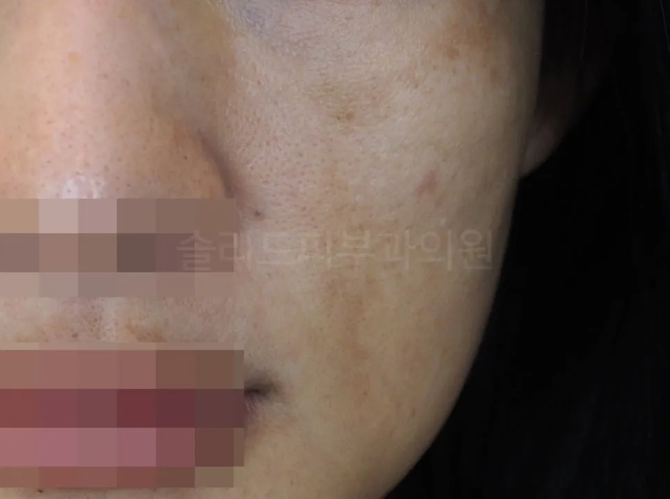 얼굴 갈색반점(기미·흑자) 관련 대표 이미지