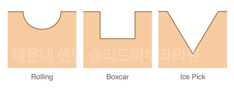 롤링·박스카·아이스픽 세 가지 패인흉터의 단면 형태를 비교한 설명 이미지
