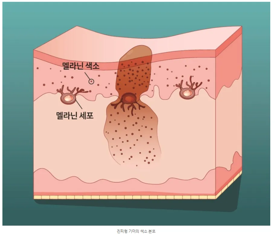 진피형 기미에서 멜라닌 색소와 멜라닌 세포가 표피·진피에 분포하는 모습을 나타낸 피부 단면 설명 이미지