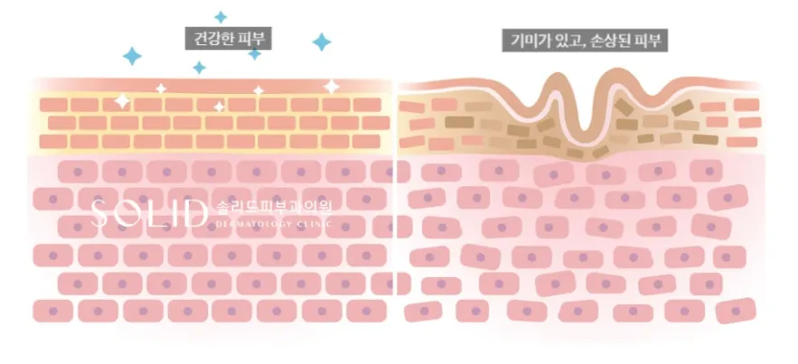 건강한 피부와 기미가 있는 손상된 피부의 표피-진피 경계 차이를 비교한 단면 설명 이미지