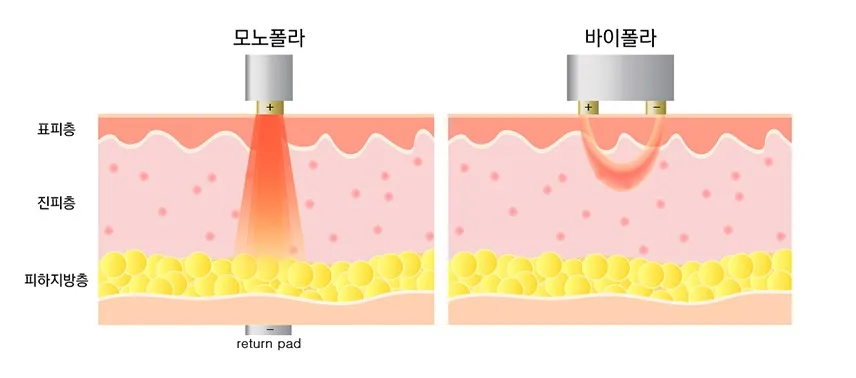 리턴패드를 이용해 수직으로 깊게 에너지를 전달하는 모노폴라와 표면 가까이 작용하는 바이폴라 고주파의 차이를 나타낸 피부 단면 설명 이미지