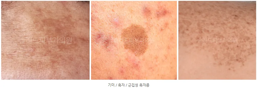 기미·흑자·군집성 흑자증의 발생 시기·형태·치료 방법을 정리한 비교표