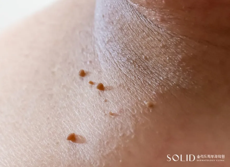목 접히는 부위에 작은 혹 모양으로 매달린 쥐젖 임상사진