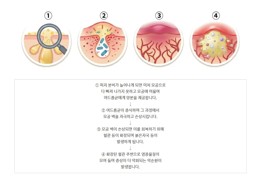 피지 분비 증가에서 여드름균 증식, 모공 벽 손상과 혈관 확장, 염증 악화로 이어지는 4단계를 나타낸 설명 이미지