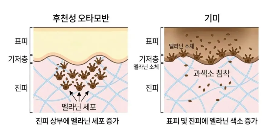 후천성 오타모반(진피 상부 멜라닌 세포 증가)과 기미(표피·진피 멜라닌 색소 증가)의 피부 단면을 비교한 설명 이미지