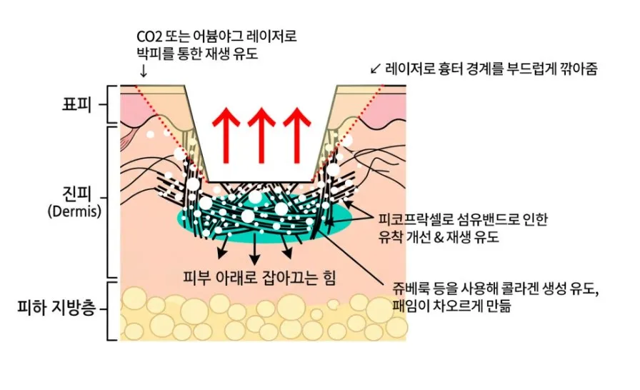 CO2·어븀야그 레이저로 흉터 경계를 깎고, 피코프락셀로 유착을 개선하며, 쥬베룩으로 콜라겐 생성을 유도하는 박스카 흉터 복합치료 원리를 나타낸 단면 설명 이미지
