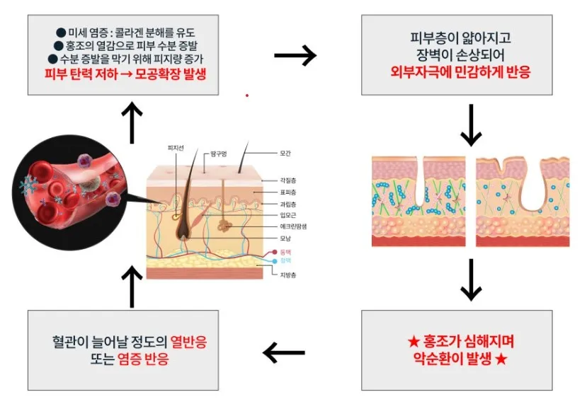 홍조가 모공 확장으로 이어지는 악순환 과정을 나타낸 설명 이미지