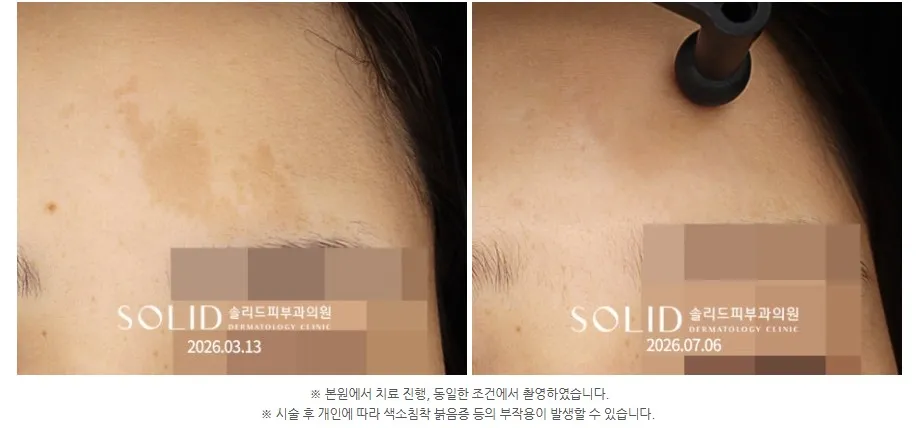 이마 밀크커피반점의 포토나 QX-MAX 11회 치료 전(2026.03.13)과 후(2026.07.06) 임상사진(본원 치료·동일 조건 촬영 안내 포함), 개인차 있음