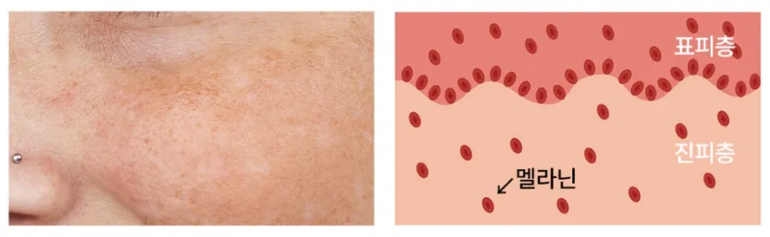 볼에 기미가 있는 피부 사진과 표피층·진피층에 멜라닌이 분포하는 단면 설명 이미지