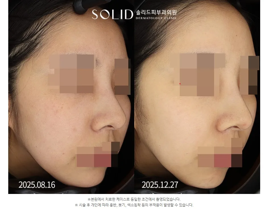 시그니처토닝 9회 전후 우측 45도 볼·광대 임상사진(본원 치료·동일 조건 촬영 안내 포함), 개인차 있음