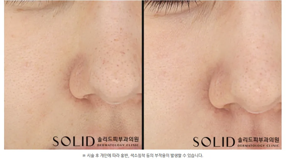 더블타이트 쥬베룩 2회 치료 전후 코 모공을 확대한 임상사진, 개인차 있음