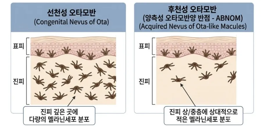 선천성 오타모반(진피 깊은 곳에 다량의 멜라닌세포)과 후천성 오타모반(진피 상·중층에 상대적으로 적은 멜라닌세포)의 분포를 비교한 단면 설명 이미지