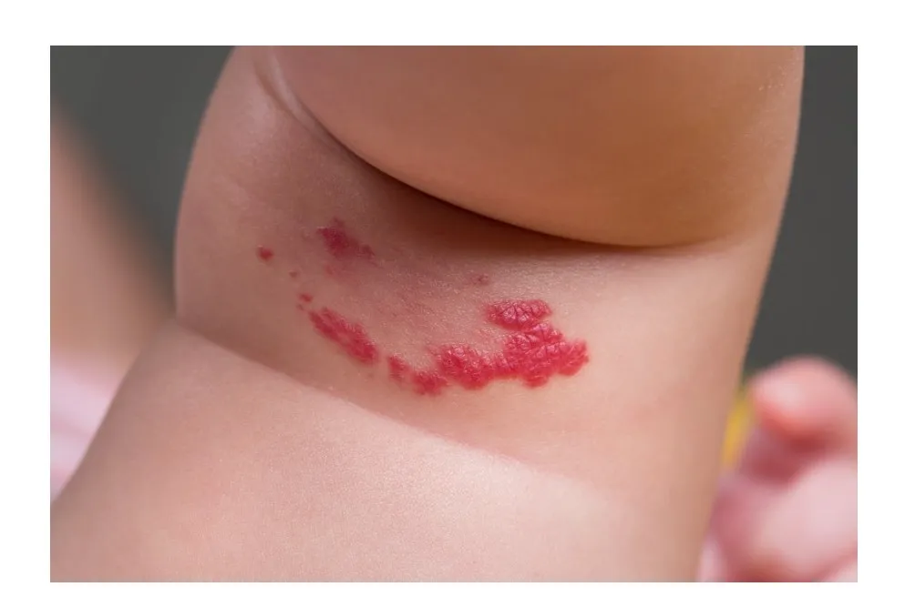 아기 목 부위에 선명한 붉은색으로 볼록하게 솟은 유아혈관종(딸기혈관종) 사진