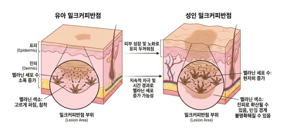 유아 밀크커피반점과 성인 밀크커피반점에서 표피 두께, 멜라닌 세포 수, 색소 분포 차이를 비교한 피부 단면 설명 이미지