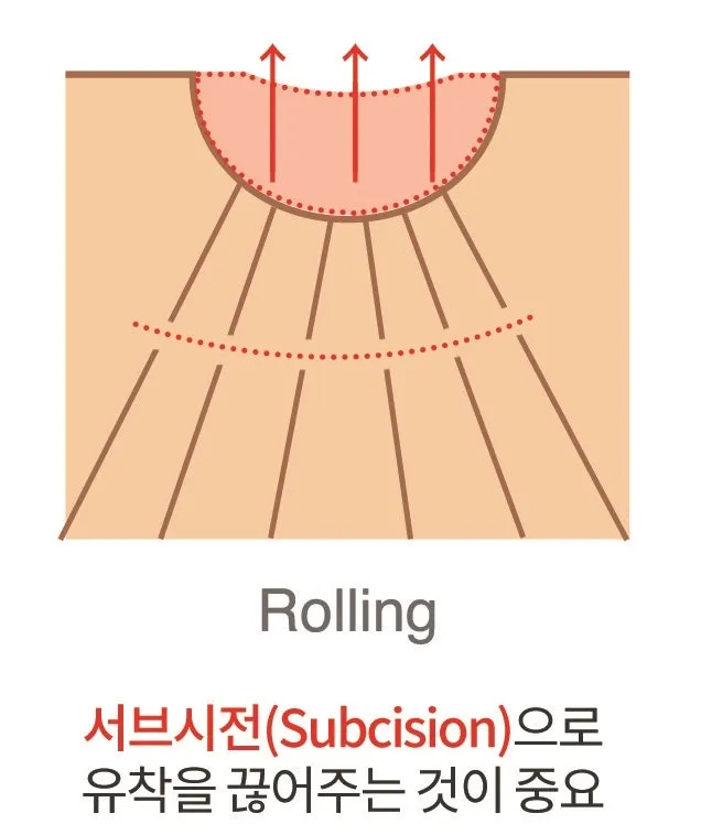 롤링흉터 아래 섬유 유착을 서브시전으로 끊어주는 원리를 나타낸 단면 설명 이미지