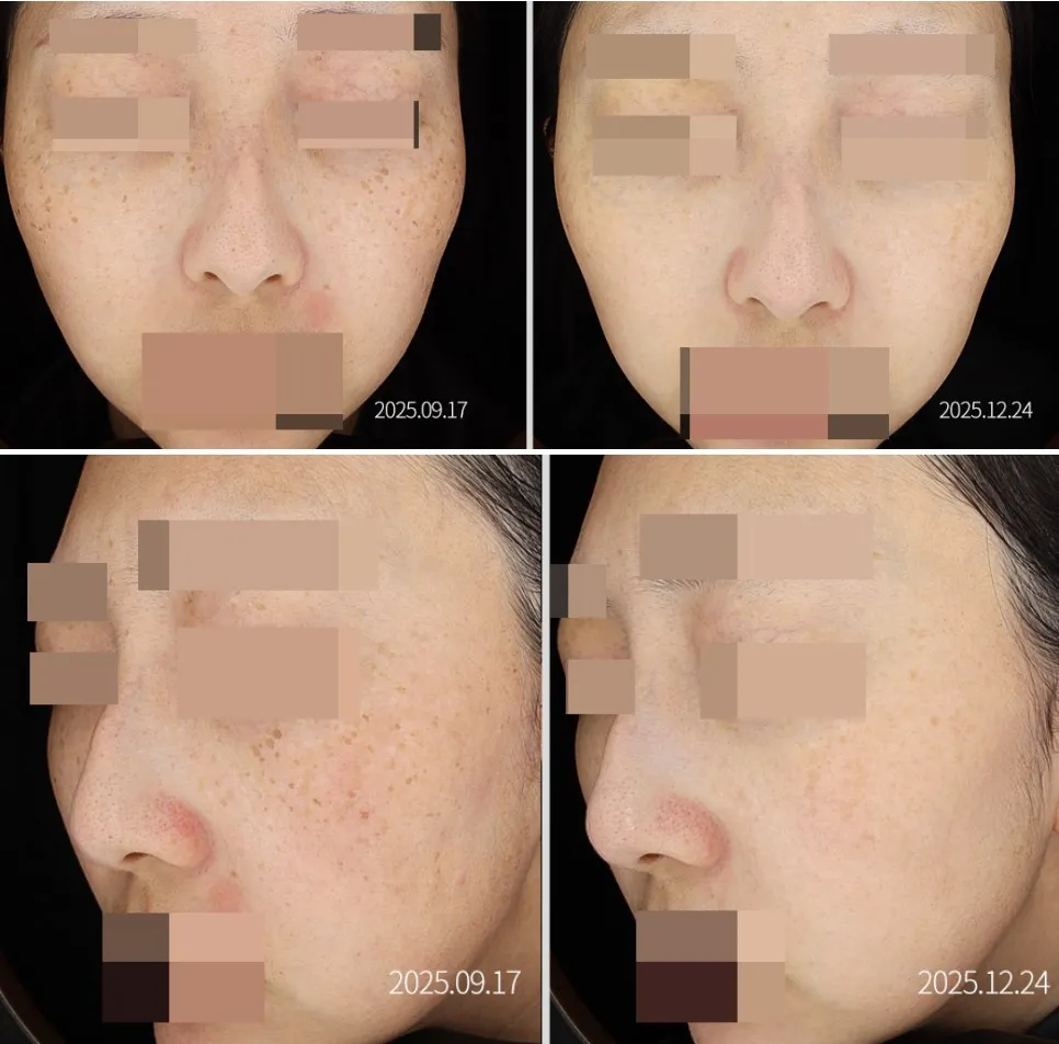 기미·잡티 복합 치료 전과 후의 얼굴 임상사진, 개인차 있음