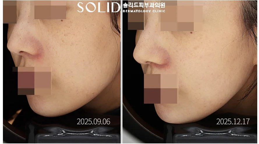 시그니처 토닝 5회 전후 좌측 볼·광대 임상사진, 개인차 있음