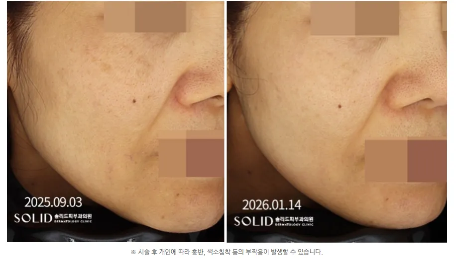 기미 복합치료 9회 전후 우측 볼 임상사진, 개인차 있음