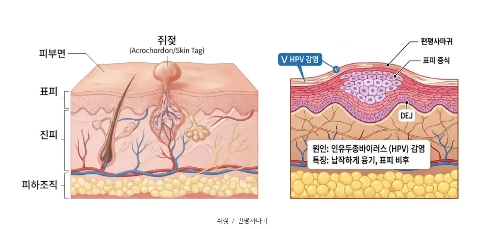 표피에서 줄기 형태로 솟은 쥐젖과 HPV 감염으로 표피가 증식한 편평사마귀의 피부 단면을 비교한 설명 이미지