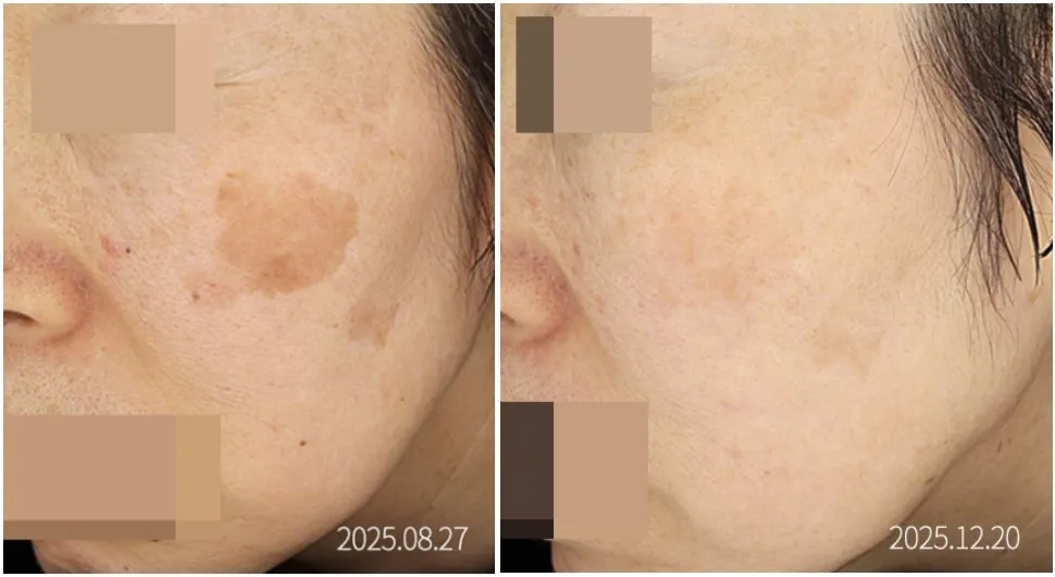 대형 흑자를 피코플러스 딱지 치료 1회로 제거한 전후 임상사진, 개인차 있음