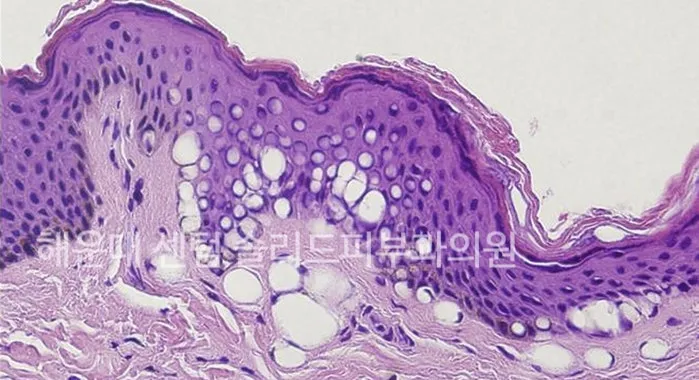 피코프락셀 LIOB 효과로 표피·진피 내에 미세한 공동이 생긴 피부 조직 현미경 사진