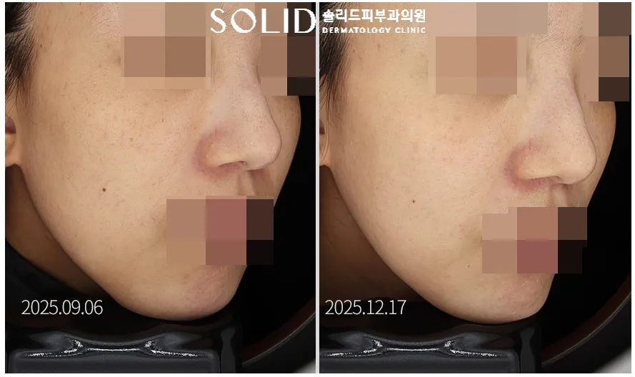 시그니처 토닝 5회 전후 우측 볼·광대 임상사진, 개인차 있음