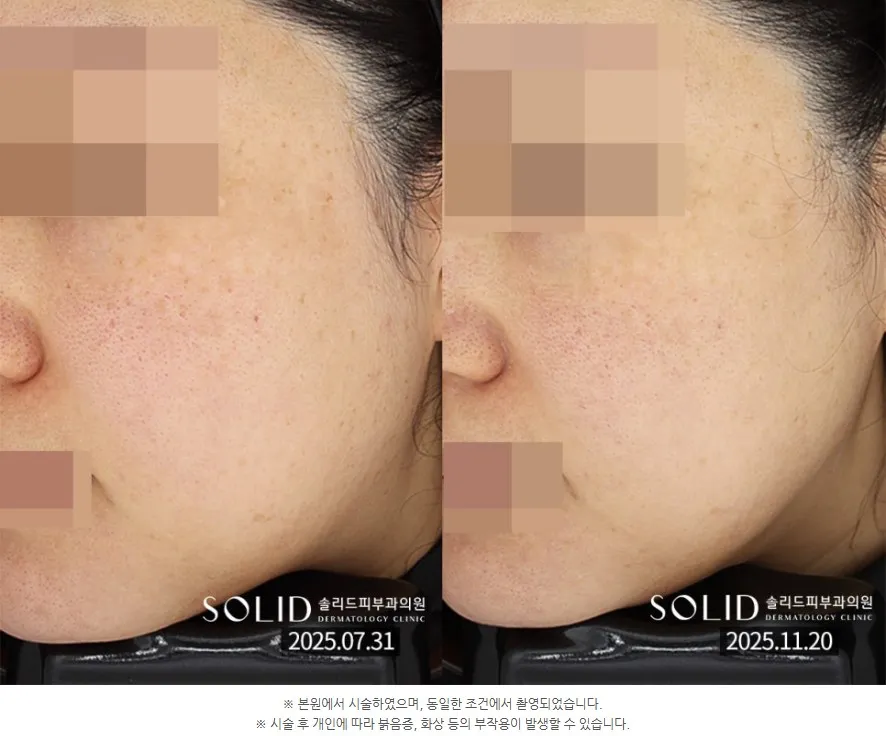 세르프 600샷 턱선리프팅 전후 우측 턱선 임상사진(본원 시술·동일 조건 촬영 안내 포함), 개인차 있음