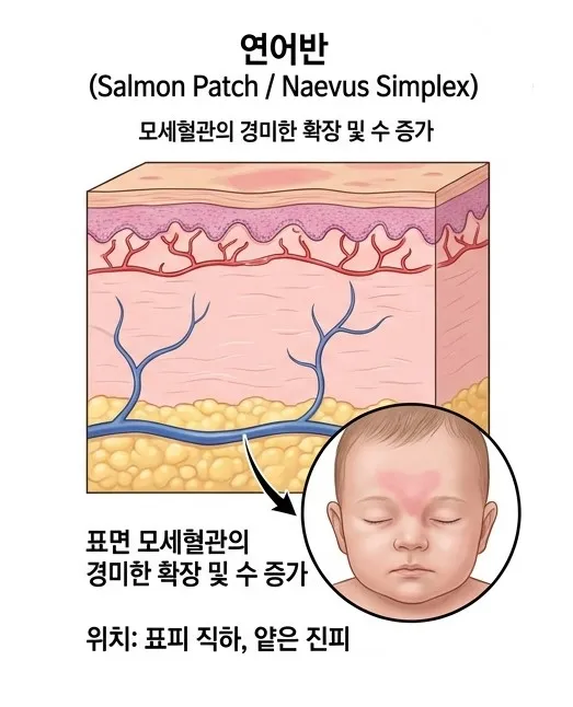 표피 직하 얕은 진피의 모세혈관이 경미하게 확장된 연어반의 단면 설명 이미지