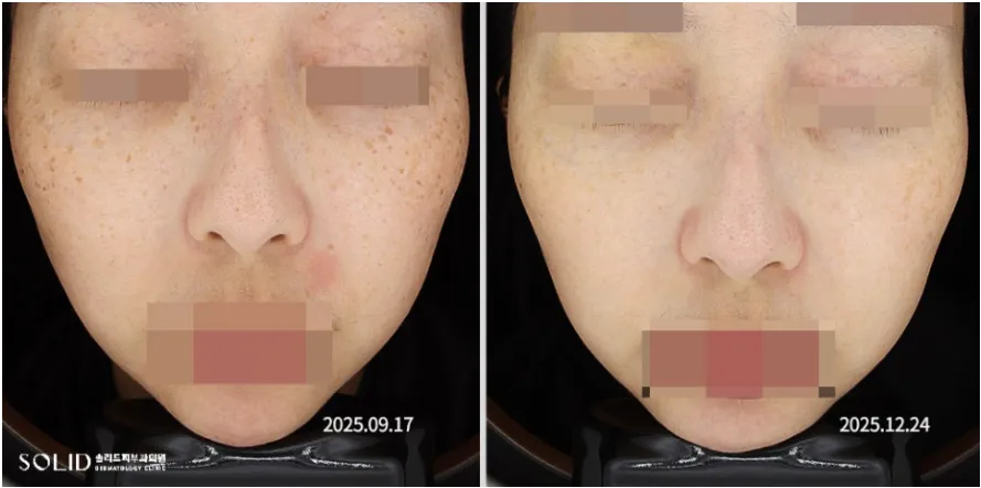 기미·군집성 흑자증 복합 치료 5회 전후 좌측면 임상사진, 개인차 있음