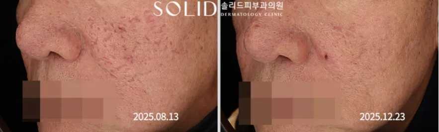 박스카 흉터 복합치료 전후 좌측 볼·코 임상사진, 개인차 있음