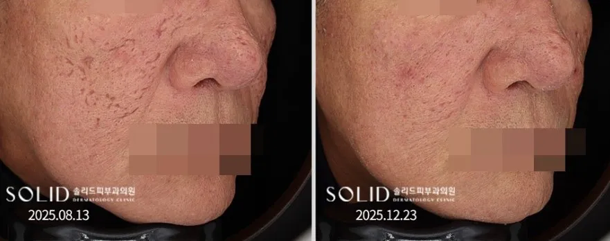 박스카 흉터 복합치료 전후 좌측 45도 볼 임상사진, 개인차 있음