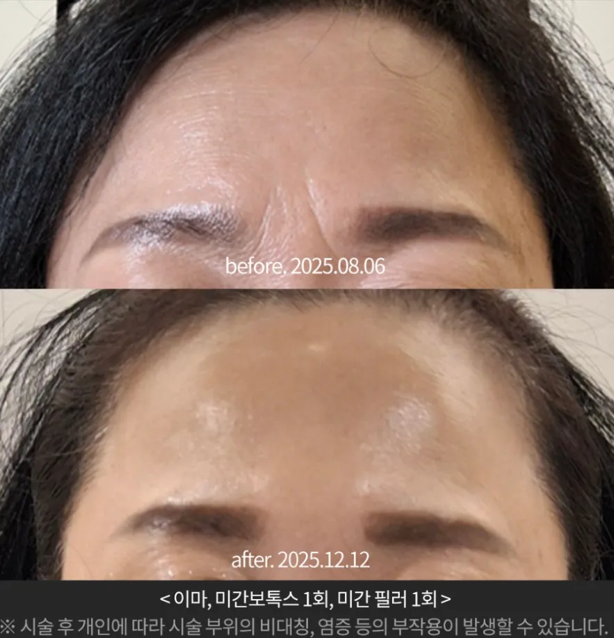 사각턱 보톡스의 주사 위치를 표시한 설명 이미지