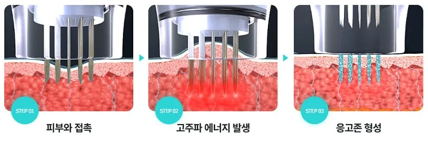 포텐자 니들이 피지선·혈관이 위치한 깊이에 고주파를 전달하는 원리를 나타낸 설명 이미지