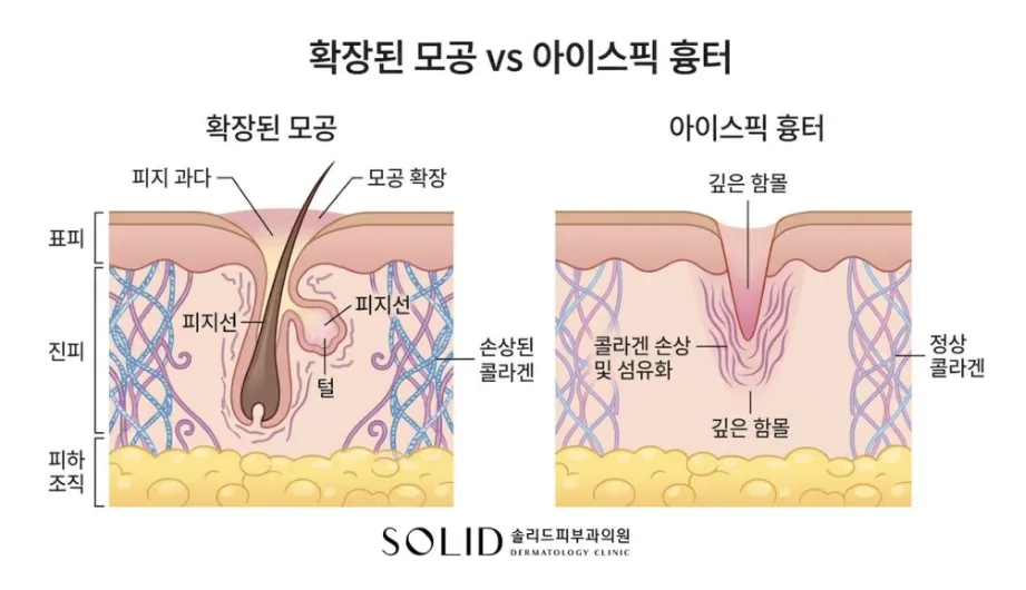 확장된 모공(피지 과다·손상된 콜라겐)과 아이스픽 흉터(깊은 함몰·콜라겐 손상 및 섬유화)의 피부 단면을 비교한 설명 이미지