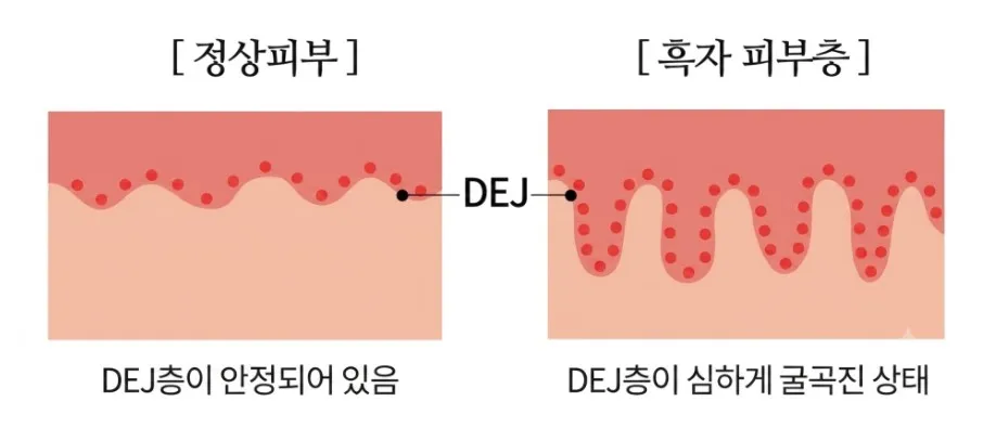 정상피부의 안정된 DEJ층과 흑자 피부층의 심하게 굴곡진 DEJ층을 비교한 단면 설명 이미지
