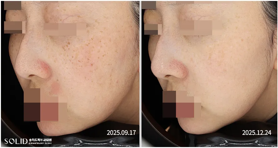 기미·군집성 흑자증 복합 치료 5회 전후 우측면 임상사진, 개인차 있음