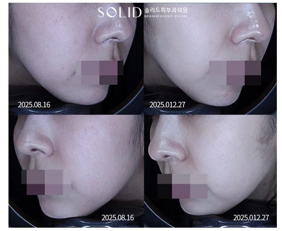 치료 전후 코 옆과 볼의 홍조·피부결을 좌우 각도로 확대 비교한 임상사진, 개인차 있음