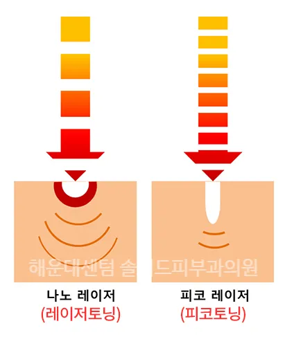 나노 레이저(레이저토닝)와 피코 레이저(피코토닝)가 피부에 에너지를 전달하는 방식 차이를 나타낸 설명 이미지