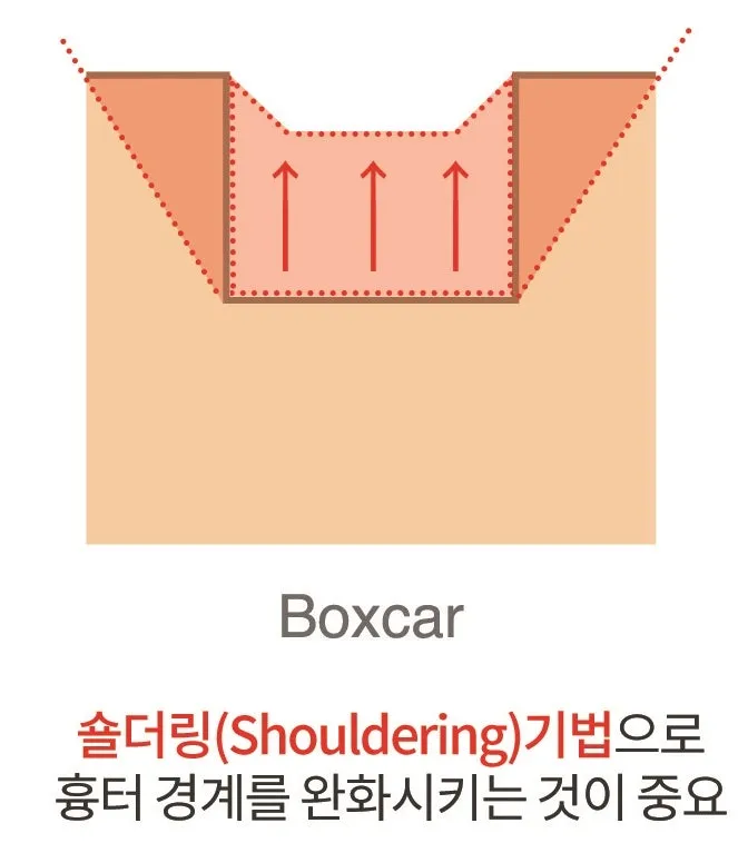 박스카흉터의 각진 경계를 숄더링 기법으로 완만하게 깎아내는 원리를 나타낸 단면 설명 이미지