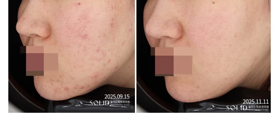 여드름·홍조 복합치료 4회 전후 좌측 볼 임상사진, 개인차 있음