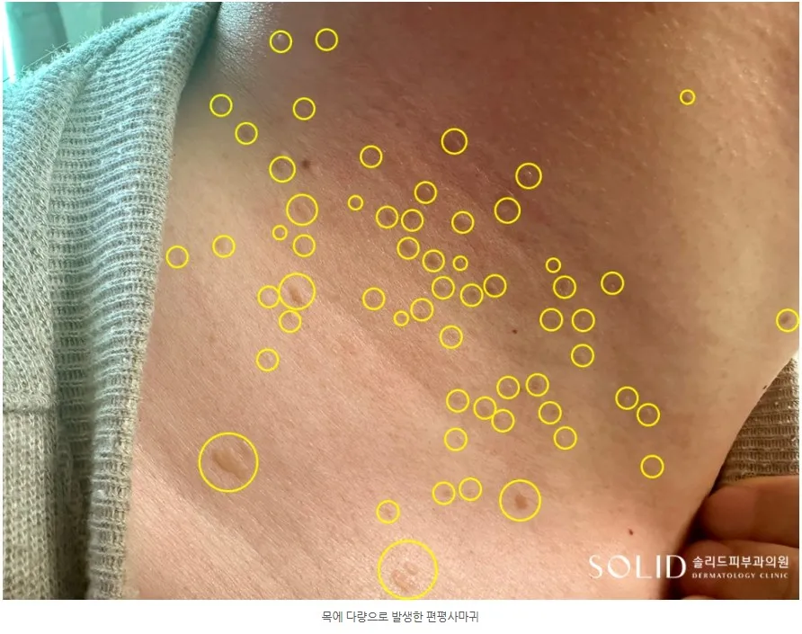 목에 다량으로 발생한 편평사마귀 병변을 노란 원으로 표시한 임상사진