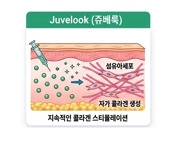 쥬베룩 입자가 섬유아세포를 자극해 자가 콜라겐을 지속적으로 생성하는 과정을 나타낸 피부 단면 설명 이미지