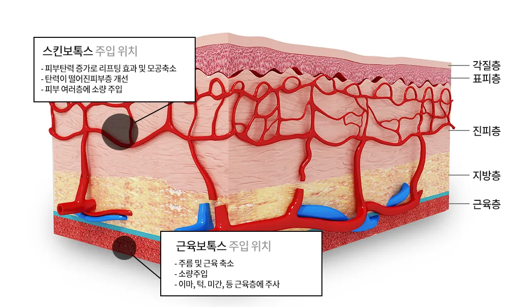 피부 단면에서 스킨보톡스(진피층)와 근육보톡스(근육층)의 주입 위치를 비교한 설명 이미지